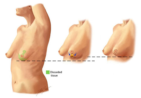 breast lift surgery tunisia